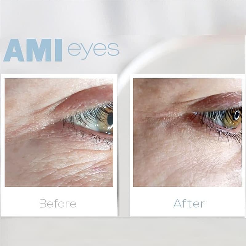 AMIeyes PN Under Eye Injection – Dark Circles & Wrinkle Repair - Image 2